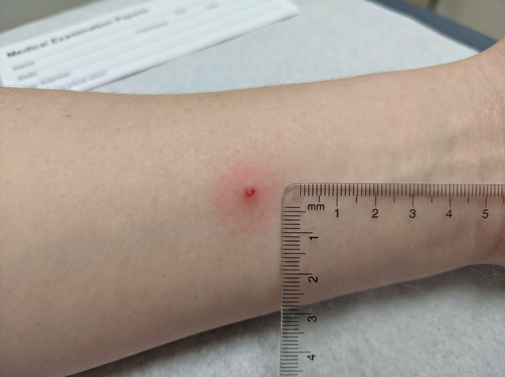 Close-up of several small red cat flea bites clustered on an ankle with a faint halo around each bump